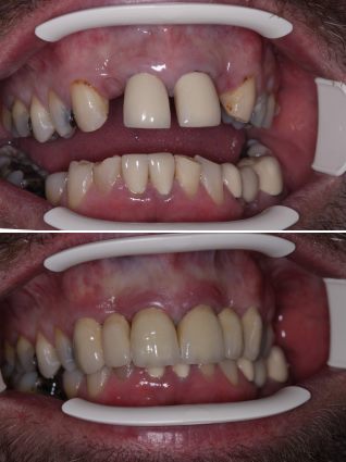 Photograph showing patient's mouth before and after the procedure
