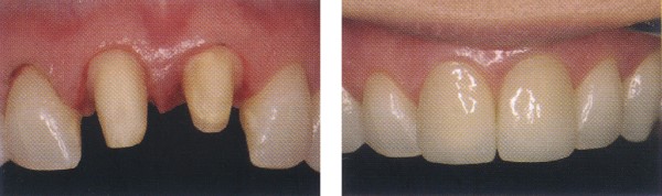 Photograph of a patient's mouth before and after fitting crowns