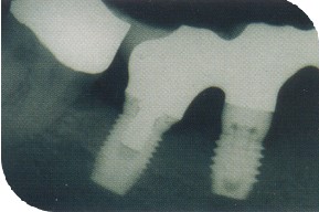 X-ray photograph showing a dental Implants
