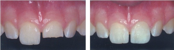 Photograph of patient's teeth before and after treatment