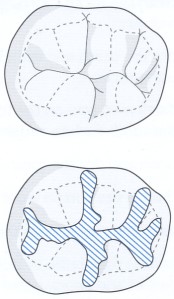 Drawing of the chewing surface of a back tooth illustrating the fissure sealant process