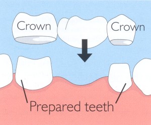 Diagram showing how a fixed bridge attaches to prepared teeth