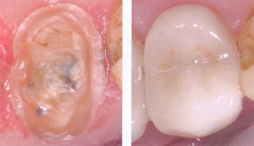 Photograph of a patient's tooth before and after the procedure