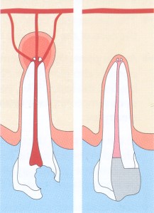 Diagram showing tooth root canals and a root filling