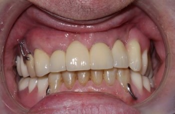 Photograph of patient's teeth after the procedure