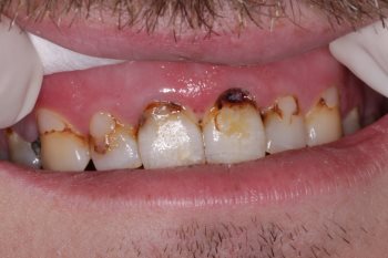Photograph of patient's teeth before the procedure