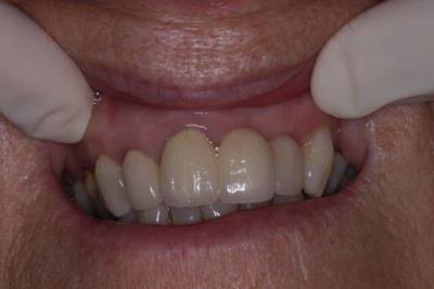 Photograph of patient's teeth after the procedure