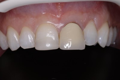 Photograph of patient's teeth before the procedure
