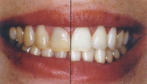 Split photograph showing patient's teeth before and after whitening
