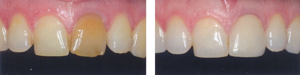 Photograph of a patient's mouth before and after porcelain veneer treatment