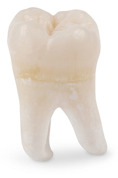 Illustration of a wisdom tooth